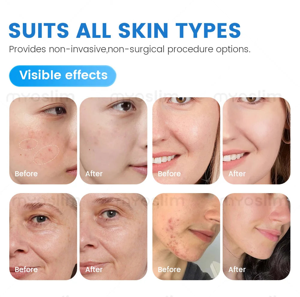 New product Multifunction Blackhead Remover